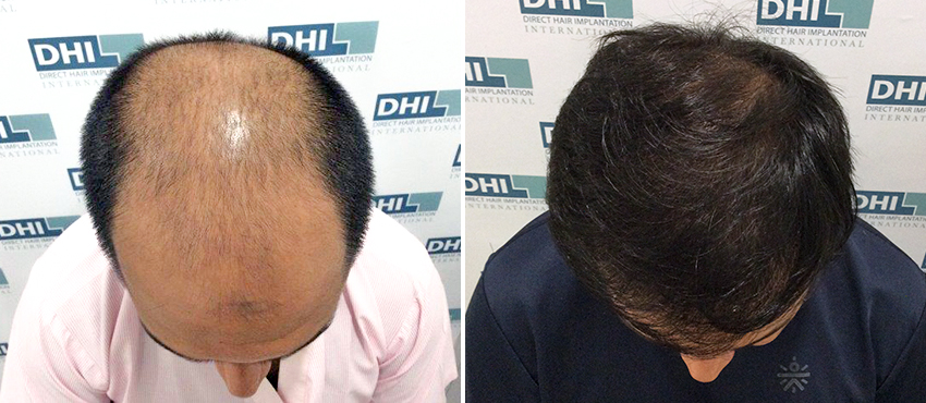 DHI before & after hair transplant results